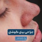 جراحی بینی گوشتی و پهن به همراه بررسی نکات مهم آن + نحوه و مراحل عمل دماغ گوشتی