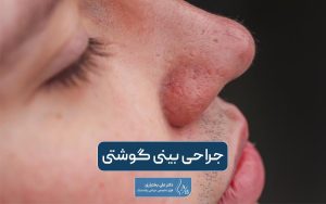 جراحی بینی گوشتی و پهن به همراه بررسی نکات مهم آن + نحوه و مراحل عمل دماغ گوشتی