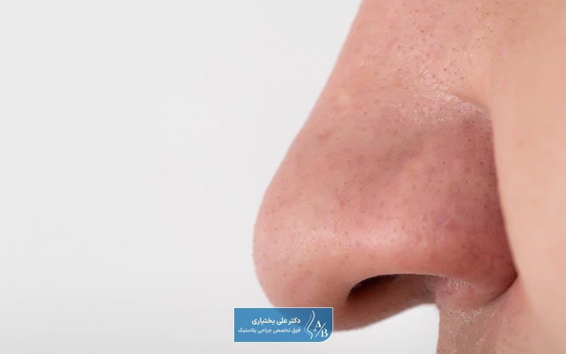 مراحل جراحی بینی گوشتی و  دماغ پهن با جزئیات کامل