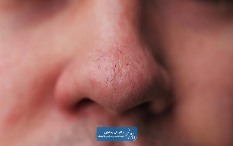 منظور از عمل جراحی بینی گوشتی و پهن چیست