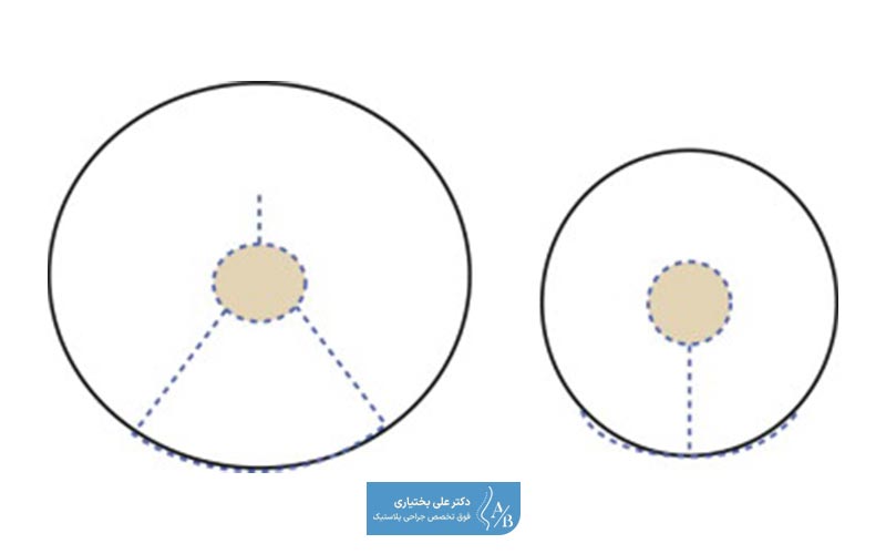 مراحل انجام جراحی لیفت سینه و کوچک کردن سینه (ماموپلاستی کاهشی) به صورت همزمان
