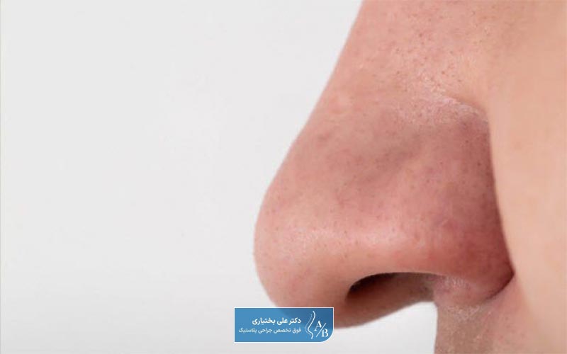 جدول و لیست قیمت عمل جراحی بینی گوشتی و پهن در سال 1404