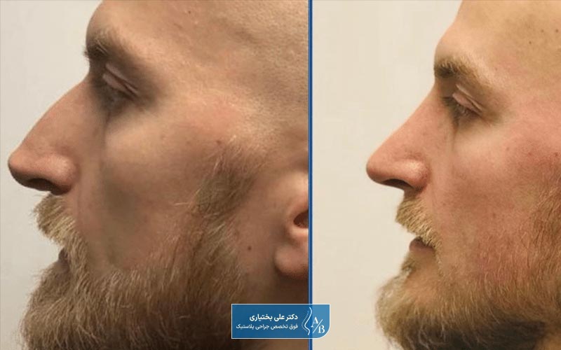 عکس قبل و بعد از جراحی بینی طبیعی مردانه