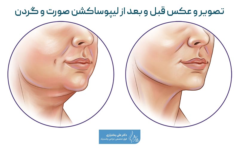 تصویر و عکس نمونه کار قبل و بعد از لیپوساکشن صورت و گردن زنان و مردان