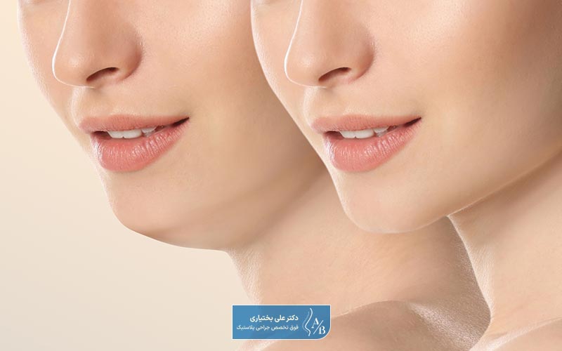 خطرات و عوارض عمل لیپوساکشن صورت و گردن
