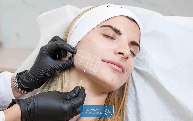 انواع نخ لیفت و کاربرد هر یک از آنها در یک نگاه