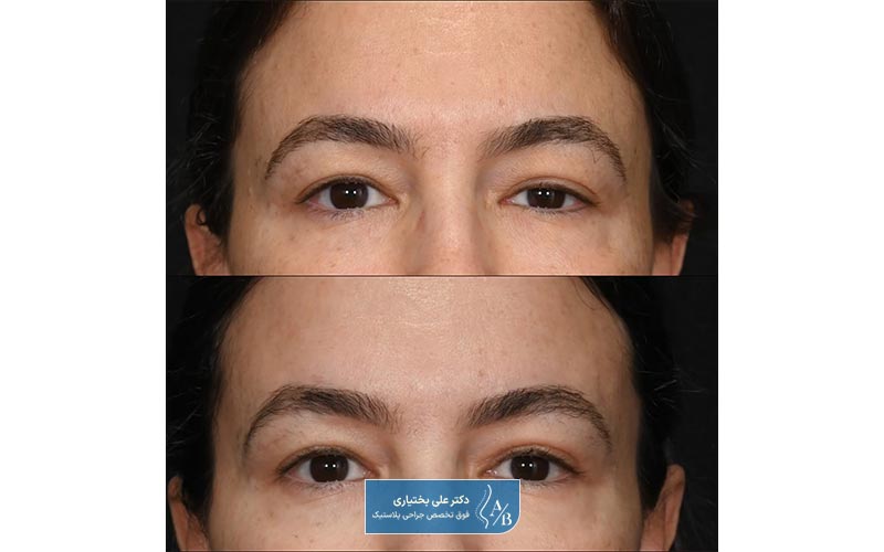 جدیدترین روش درمان افتادگی پلک کدام است؟