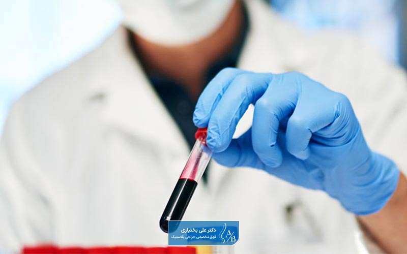 آزمایش گروه خونی قبل از جراحی رینوپلاستی و بینی