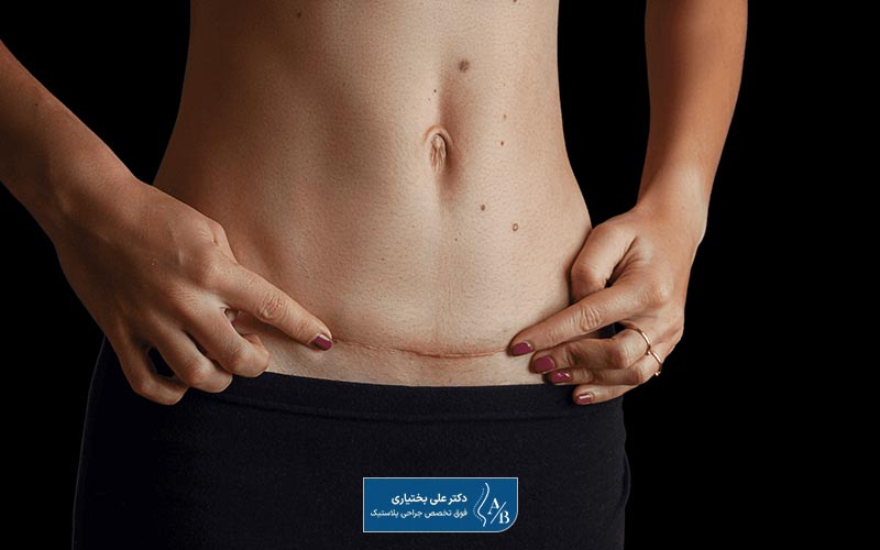 علت انجام عمل ابدومینوپلاستی و تصویر جای زخم عمل زیبایی شکم