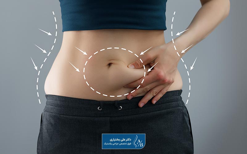 چه نکاتی را در مراقبت های بعد از ابدومینوپلاستی و جراحی زیبایی شکم باید رعایت کنیم؟