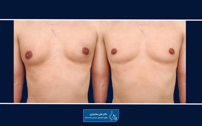 بررسی تفاوت ژنیکوماستی و چربی سینه در مردان