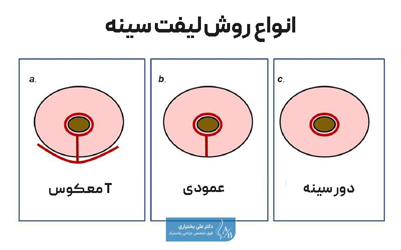 انواع روش لیفت سینه و ماستوپکسی در زنان و کاربرد هر یک