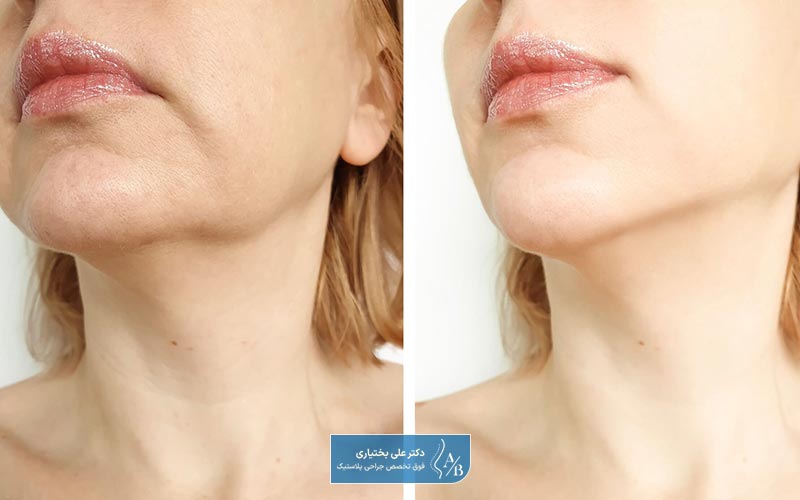 افزایش اعتماد به نفس یکی از مزایای مینی فیس لیفت است