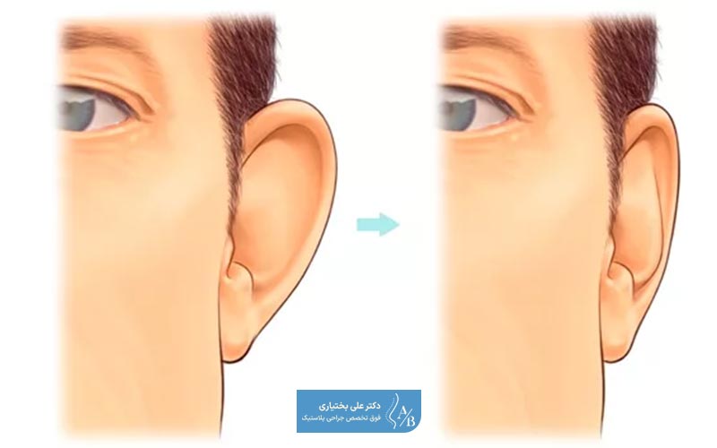 هزینه اتوپلاستی و قیمت جراحی گوش در سال 1404 چقدر است؟