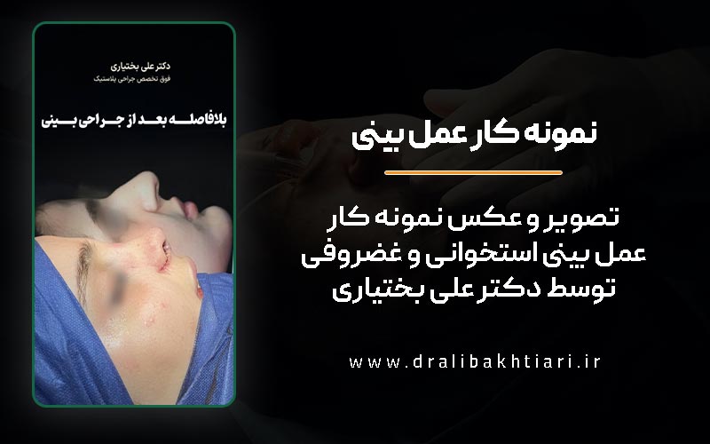 تصویر نمونه کار عمل بینی استخوانی و تبدیل آن به بینی نیمه فانتزی