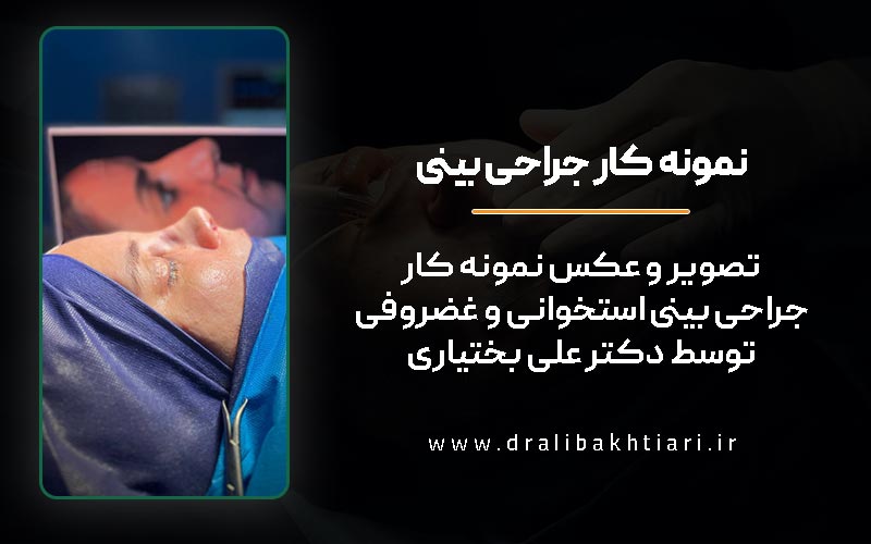 عکس قبل و بعد نمونه کار جراحی بینی استخوانی و گوشتی از دکتر علی بختیاری