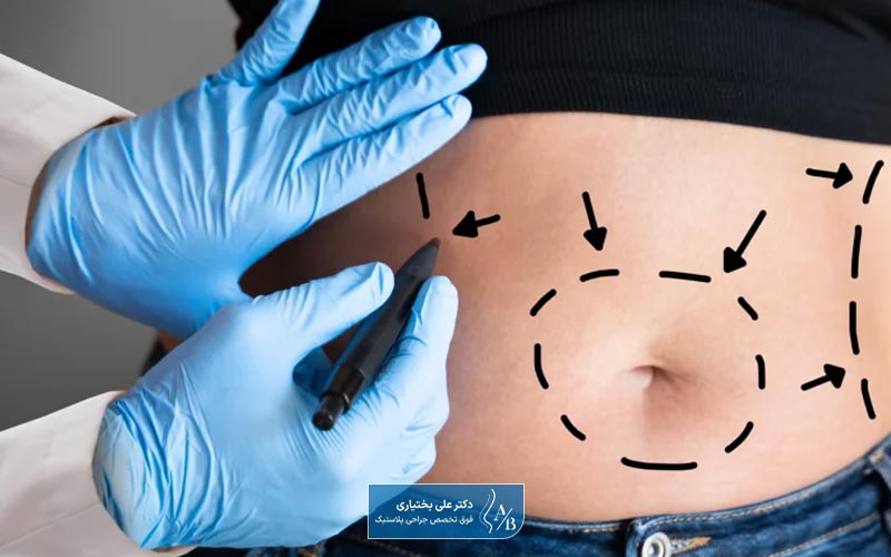 جراحی زیبایی شکم یا ابدومینوپلاستی (تامی تاک) چیست