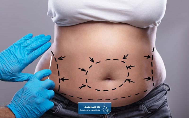 عوارض ابدومینوپلاستی شکم