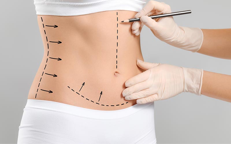 ابدومینوپلاستی چگونه انجام میشود؟ مراحل عمل جراحی زیبایی شکم