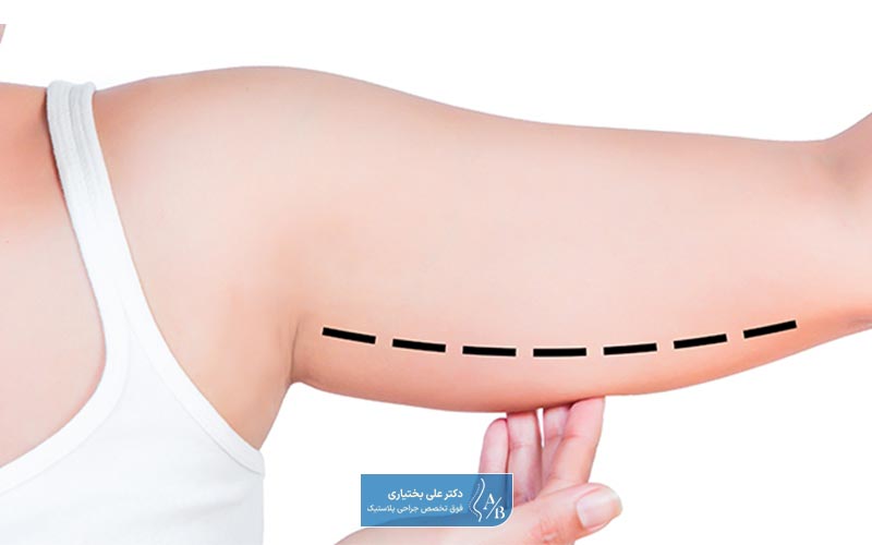 مزایای عمل جراحی لیفت بازو و براکیوپلاستی در یک نگاه