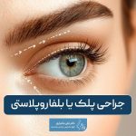 جراحی پلک یا بلفاروپلاستی چیست؟ انواع مزایا و عوارض عمل زیبایی پلک