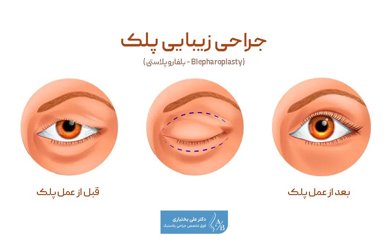 خطرات و عوارض عمل زیبایی پلک در زنان و مردان چیست