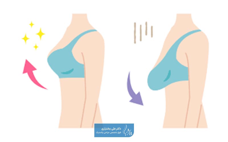 عکس قبل و بعد از لیفت سینه و پستان در زنان