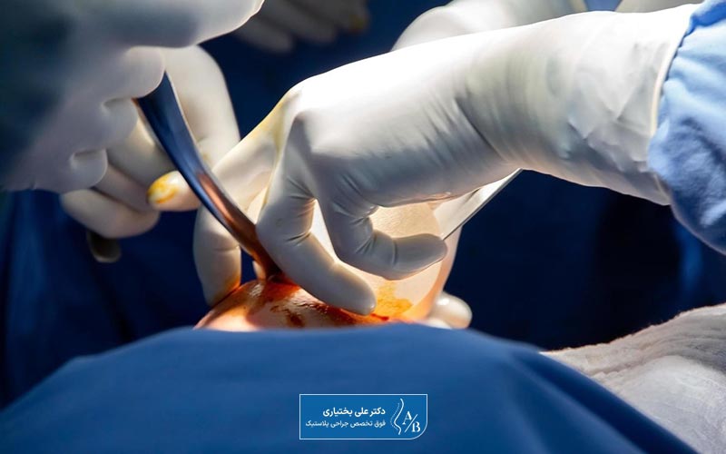 قیمت و هزینه جراحی پروتز سینه در تهران در سال 1404