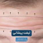 لیفت پیشانی چیست؟ انواع روش و تکنیک‌های عمل لیفت پیشانی زنان و مردان