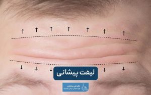 لیفت پیشانی چیست؟ انواع روش و تکنیک‌های عمل لیفت پیشانی زنان و مردان