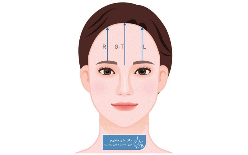 لیفتینگ پیشانی با عمل جراحی باز یکی از تکنیک‌های این جراحی است