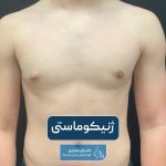 عمل ژنیکوماستی چیست؟ جراحی کوچک کردن سینه در مردان و آقایان و نکات آن