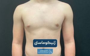 عمل ژنیکوماستی چیست؟ جراحی کوچک کردن سینه در مردان و آقایان و نکات آن