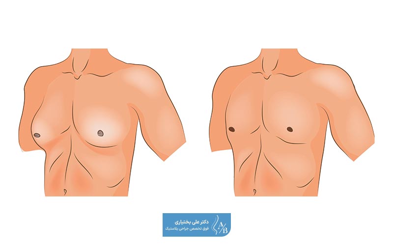تصویر و عکس قبل و بعد از عمل ژنیکوماستی مردانه + مراحل جراحی