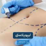 لیپوپلاستی چیست و چه مزایا و معایبی این عمل لاغری دارد؟