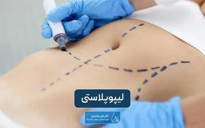 لیپوپلاستی چیست و چه مزایا و معایبی این عمل لاغری دارد؟