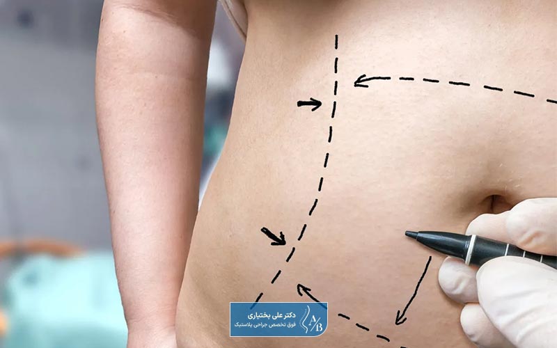 مزایا و معایب پیکرتراشی به سبک لیپو پلاستی