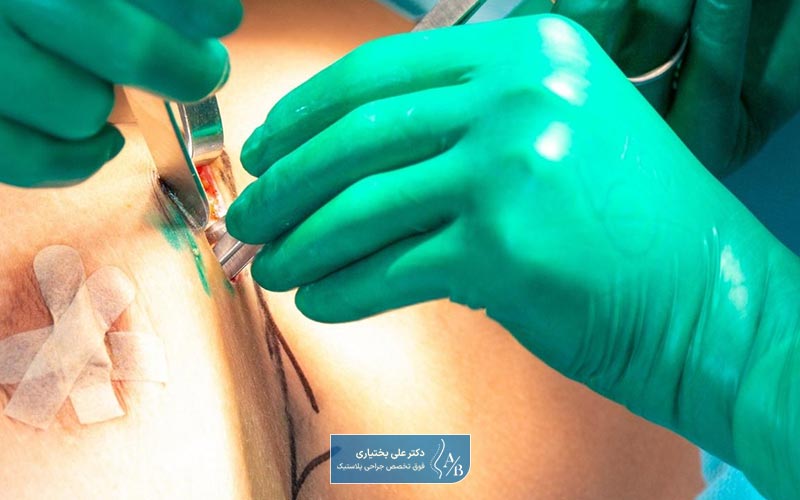 عوارض عمل جراحی ماموپلاستی در زنان چیست