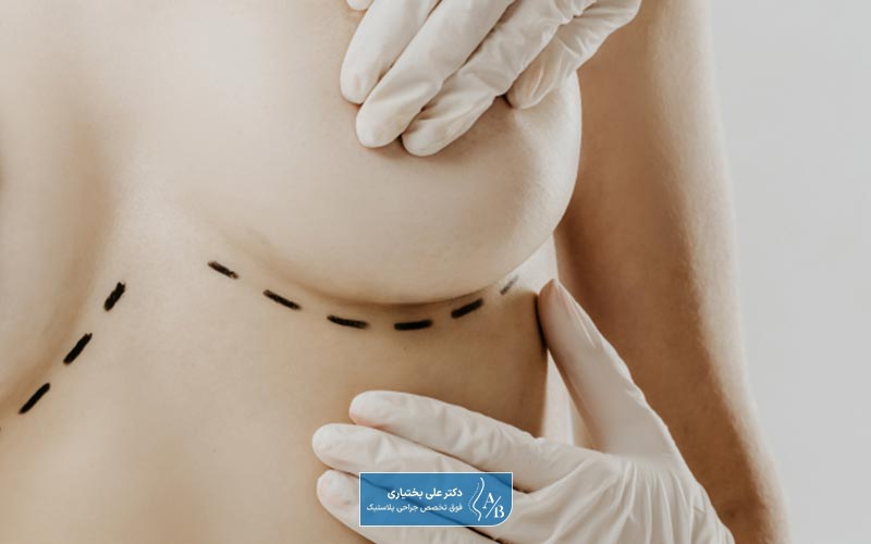 عمل کوچک کردن سینه یا جراحی ماموپلاستی کاهشی یکی از انواع جراحی زیبایی سینه در زنان