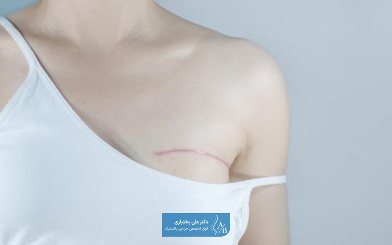 لامپکتومی یک از روش های عمل ماستکتومی و تخلیه سینه در زنان است