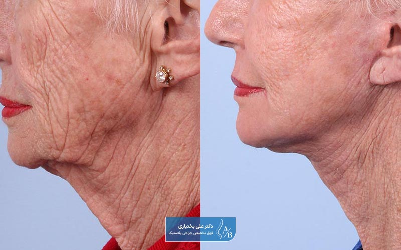 عکس قبل و بعد از عمل جراحی مینی لیفت صورت و هزینه آن در سال ۱۴۰۴ + عوارض و خطرات آن