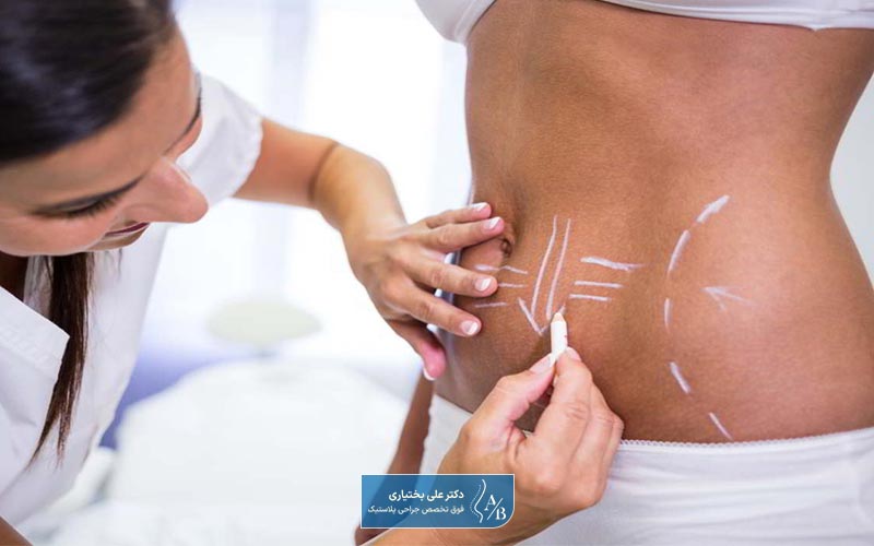 یکی از انواع جراحی پلاستیک زیبایی، عمل ابدومینوپلاستی شکم است