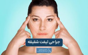 جراحی لیفت شقیقه چیست و انواع روش و تکنیک عمل آن