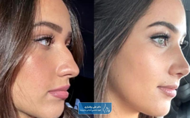 عوارض عمل نوک بینی به همراه عکس قبل و بعد از جراحی نوک بینی