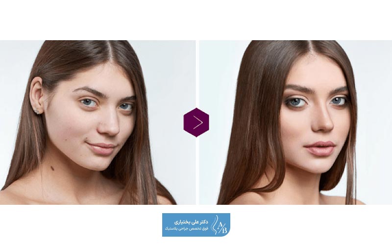 نتایج بعد از عمل نوک بینی و تصویر و عکس قبل و بعد از آن