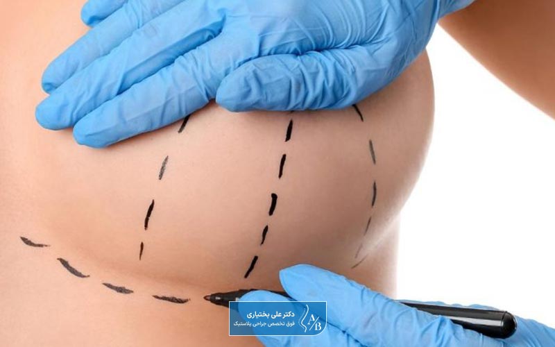 ایجاد برش در سینه زنان و تخلیه بافت چربی و غیره از مراحل عمل جراحی ماموپلاستی کاهشی است