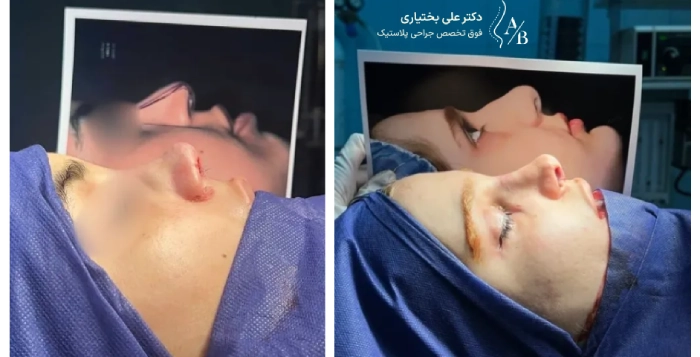 هزینه عمل بینی