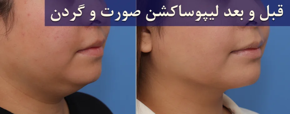 قبل و بعد لیپوساکشن صورت و گردن